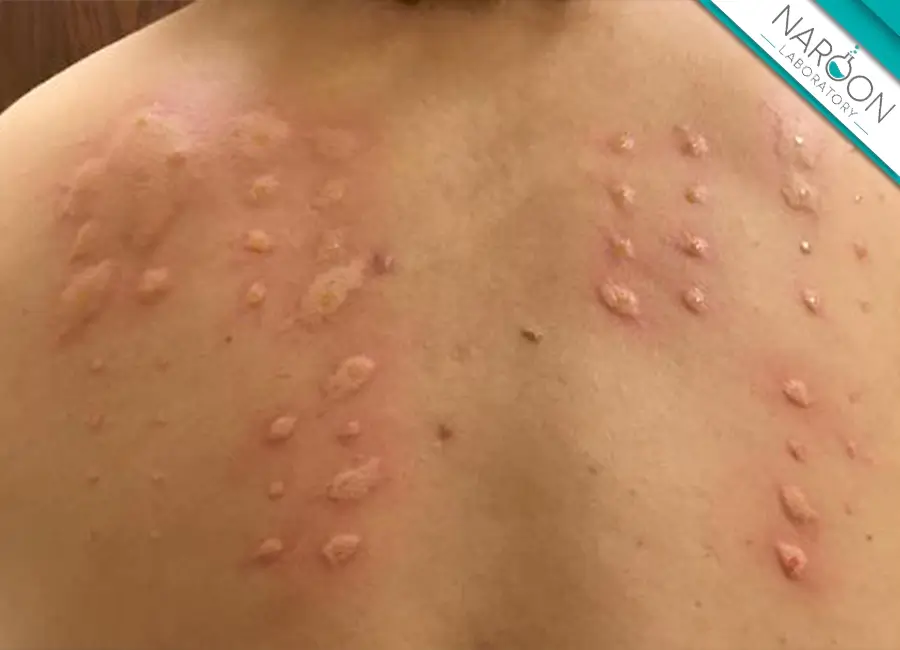 نحوه انجام تست آلرژی