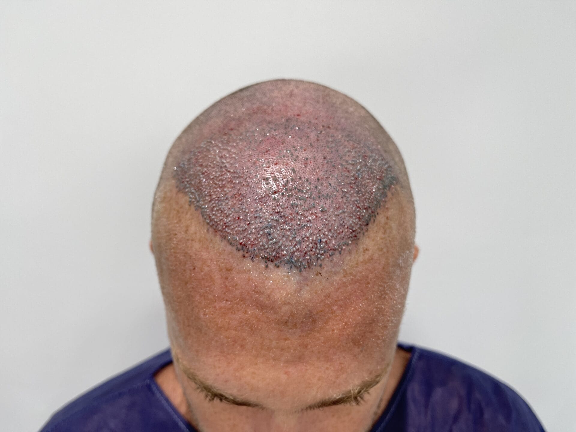 swelling-after-hair-transplant.jpg