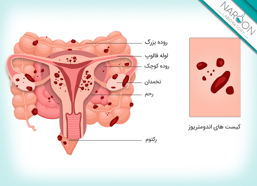 عوارض اندومتریوز