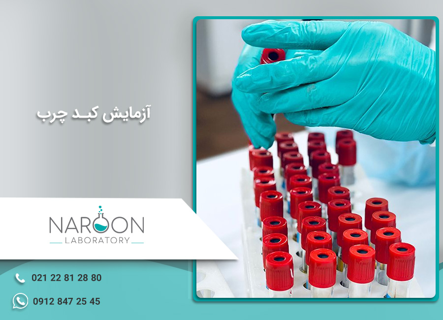 آزمایش کبد چرب