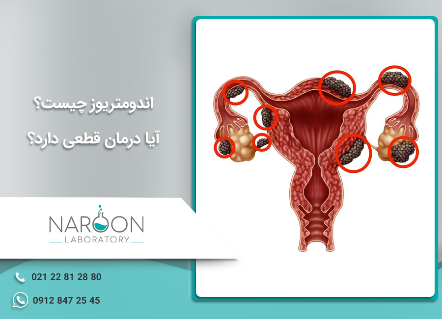 اندومتریوز چیست