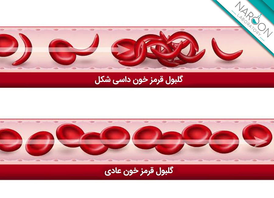 مقایسه سلول خونی نرمال و داسی شکل